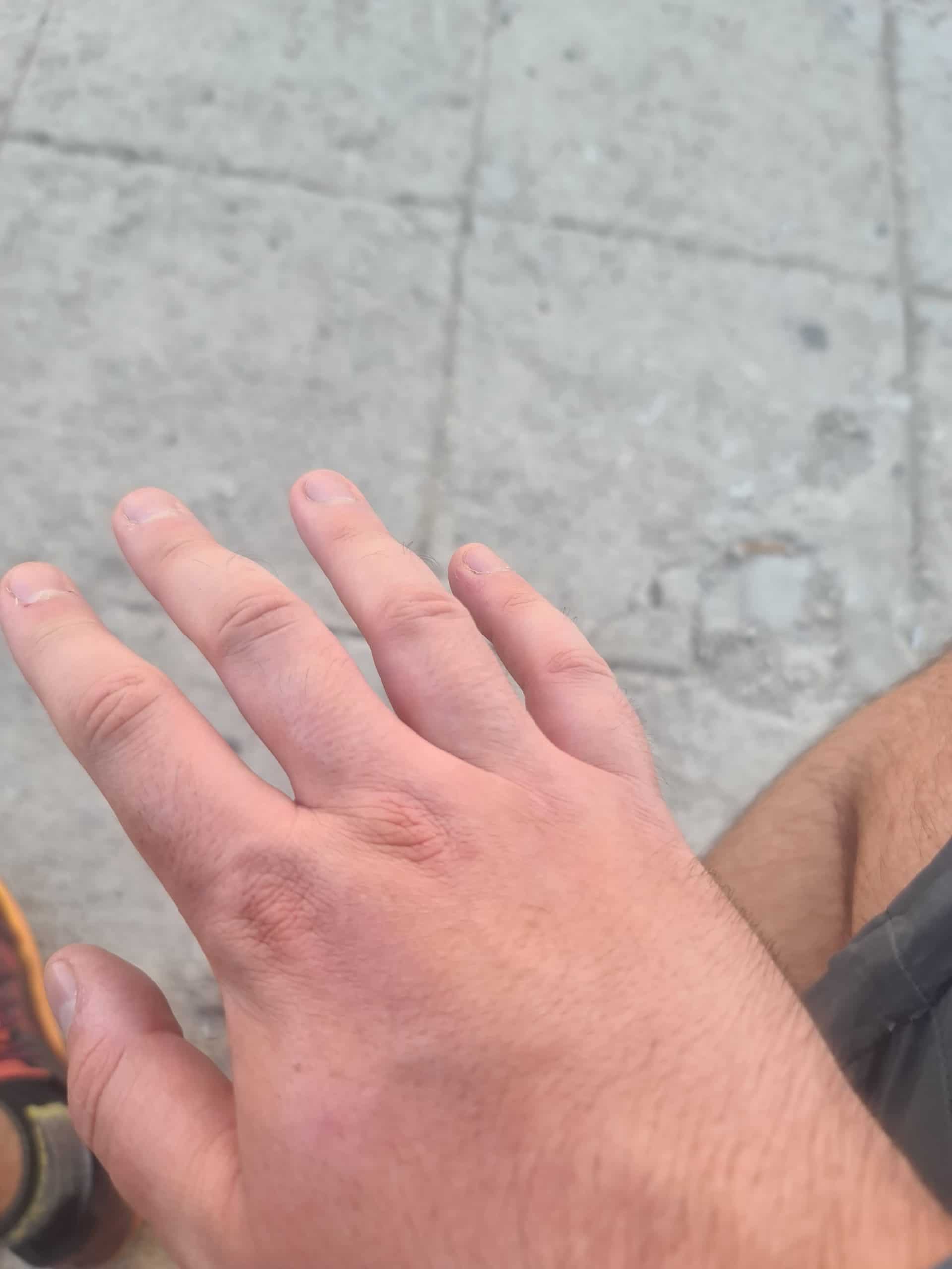 fat fingers when hiking swollen hands